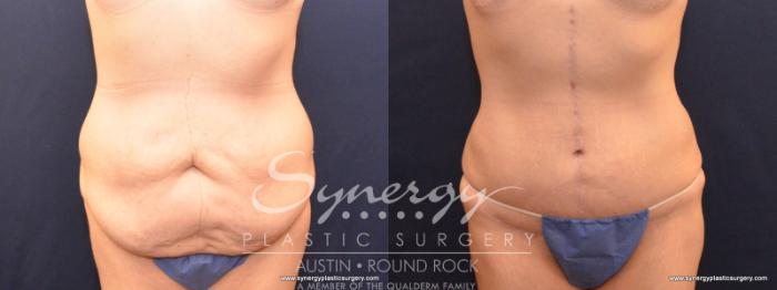 Before & After Fleur-de-Lis Tummy Tuck Case 570 View #1 View in Austin, TX