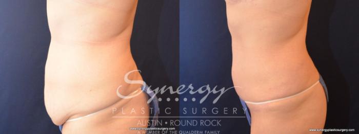 Before & After Fleur-de-Lis Tummy Tuck Case 570 View #2 View in Austin, TX
