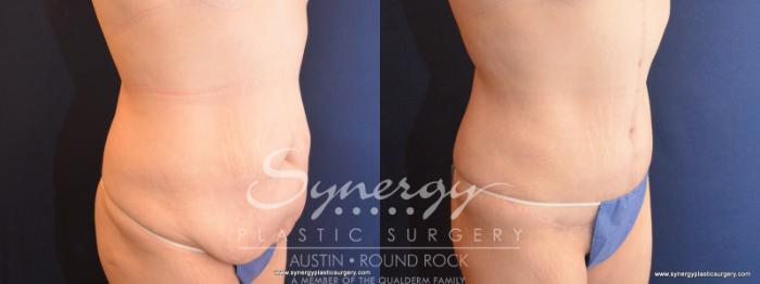 Before & After Fleur-de-Lis Tummy Tuck Case 570 View #3 View in Austin, TX