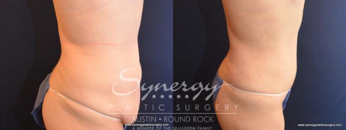 Before & After Fleur-de-Lis Tummy Tuck Case 570 View #4 View in Austin, TX
