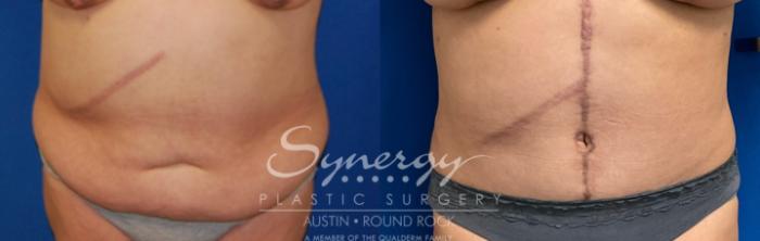 Fleur-de-Lis Tummy Tuck Before and After Photo Gallery, Austin, TX