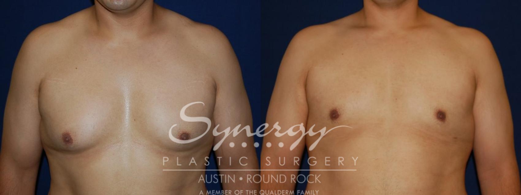 Before & After Gynecomastia/Male Chest Contouring Case 109 View #1 View in Round Rock, TX