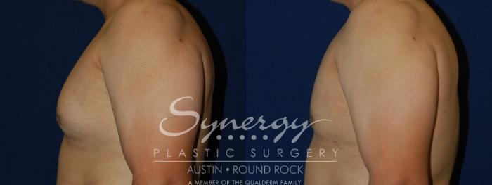 Before & After Gynecomastia/Male Chest Contouring Case 109 View #2 View in Austin, TX
