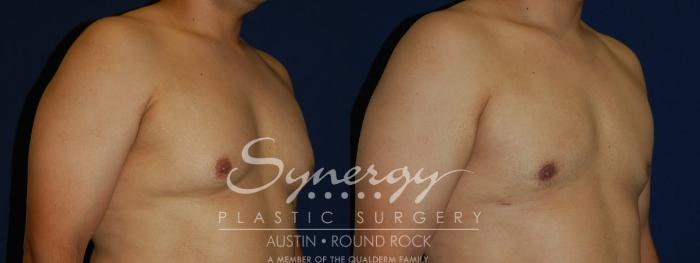 Before & After Gynecomastia/Male Chest Contouring Case 109 View #3 View in Austin, TX