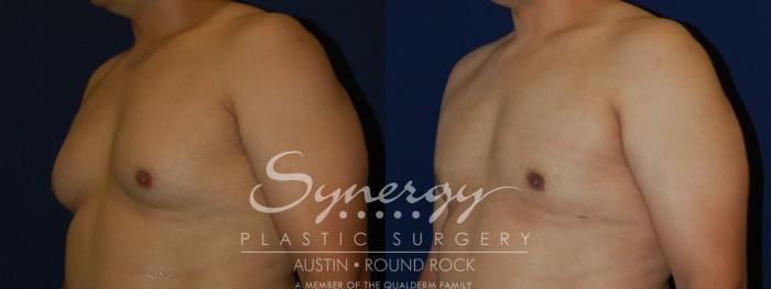 Before & After Gynecomastia/Male Chest Contouring Case 109 View #4 View in Austin, TX