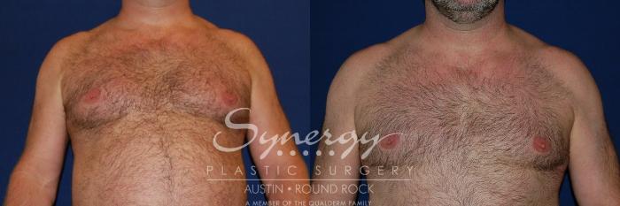 Before & After Gynecomastia/Male Chest Contouring Case 125 View #1 View in Austin, TX