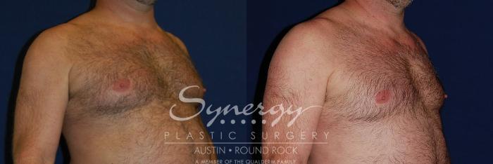 Before & After Gynecomastia/Male Chest Contouring Case 125 View #2 View in Austin, TX