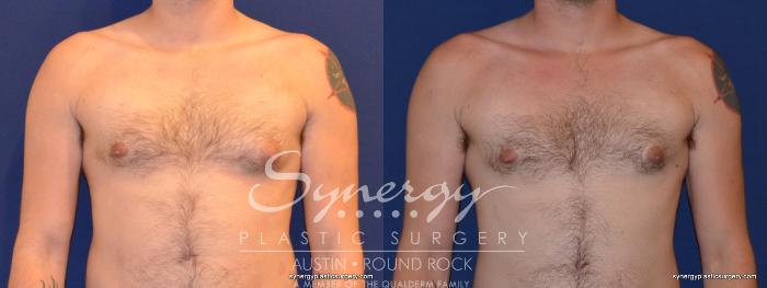 Before & After Gynecomastia/Male Chest Contouring Case 282 View #1 View in Austin, TX