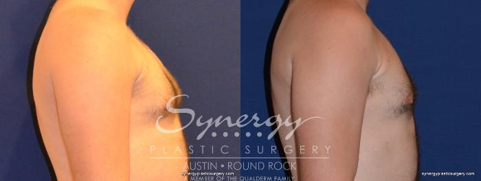 Before & After Gynecomastia/Male Chest Contouring Case 282 View #2 View in Austin, TX