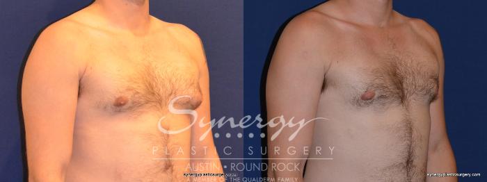 Before & After Gynecomastia/Male Chest Contouring Case 282 View #3 View in Austin, TX