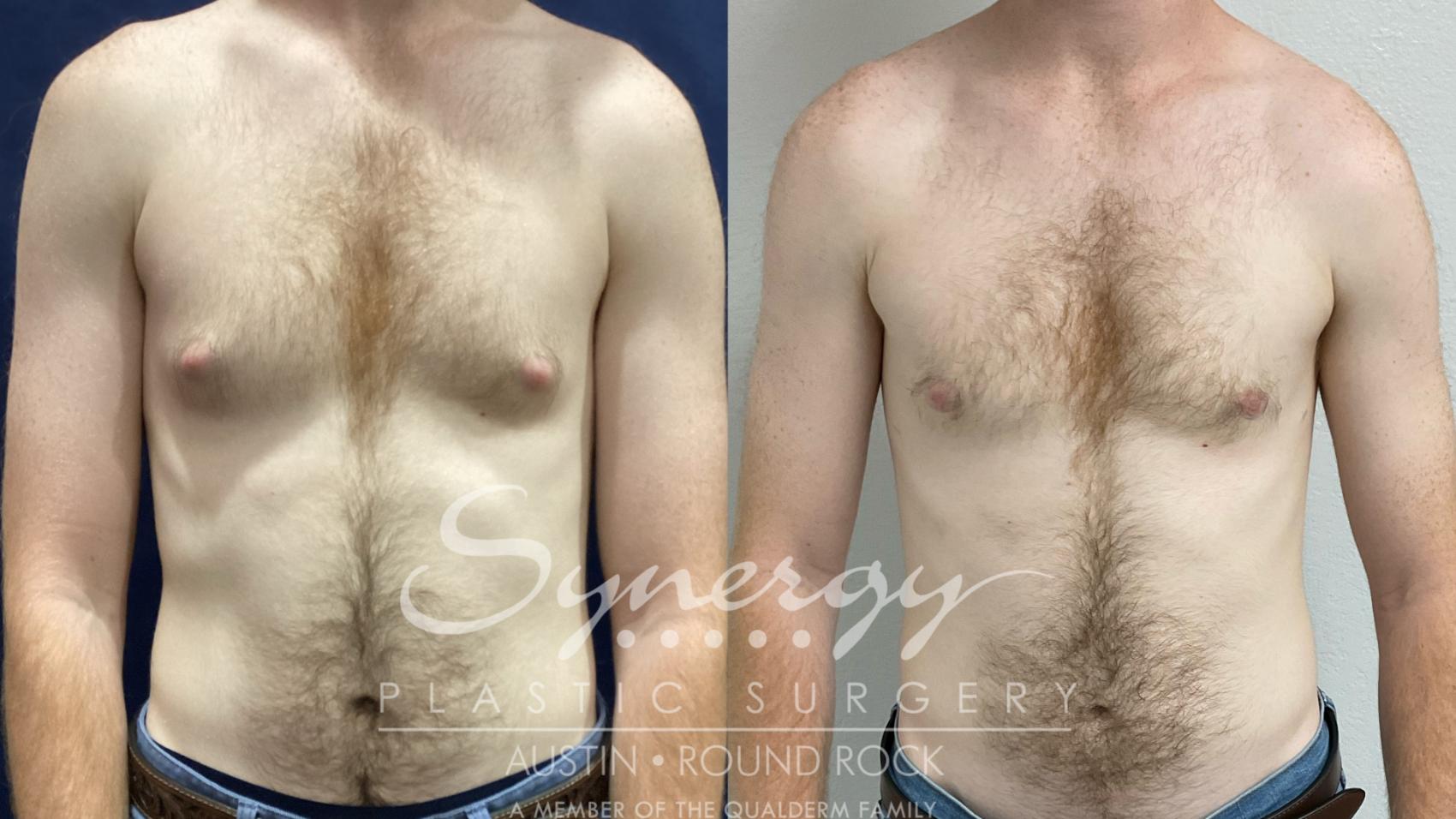 Before & After Gynecomastia/Male Chest Contouring Case 894 Front View in Austin, TX