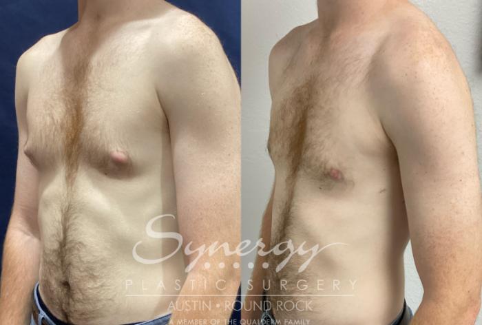 Before & After Gynecomastia/Male Chest Contouring Case 894 Left Oblique View in Austin, TX