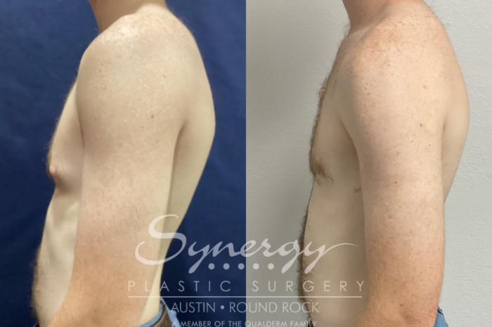 Before & After Gynecomastia/Male Chest Contouring Case 894 Left Side View in Austin, TX