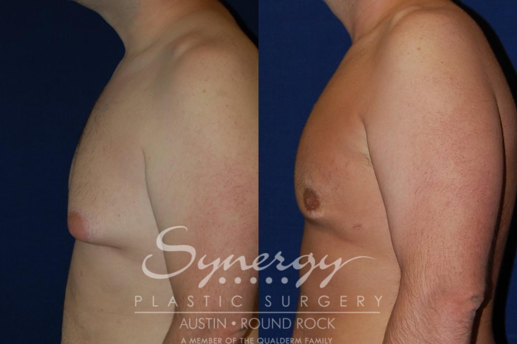 Before & After Gynecomastia/Male Chest Contouring Case 92 View #1 View in Austin, TX