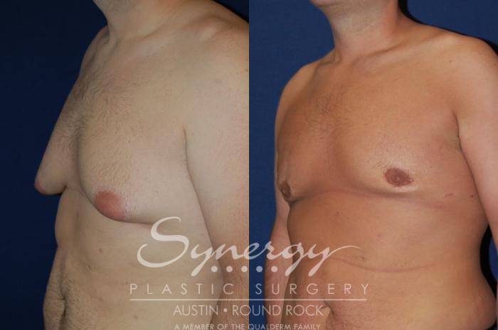 Before & After Gynecomastia/Male Chest Contouring Case 92 View #2 View in Austin, TX