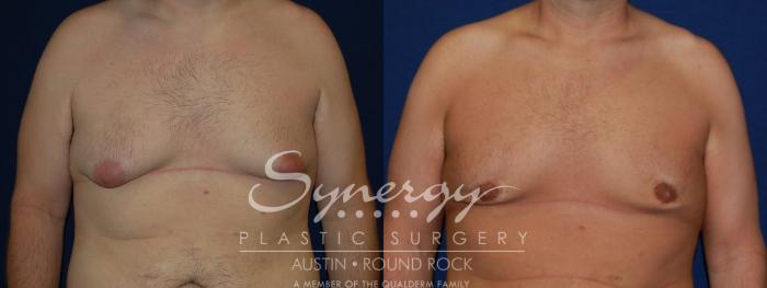 Before & After Gynecomastia/Male Chest Contouring Case 92 View #3 View in Austin, TX