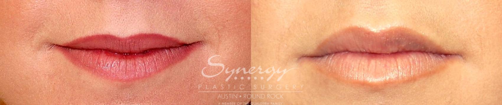 Before & After Injectable Fillers (Lips) Case 16 View #1 View in Austin, TX