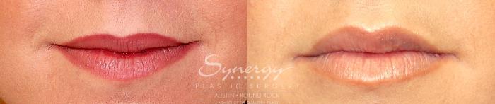 Before & After Injectable Fillers (Lips) Case 16 View #1 View in Austin, TX