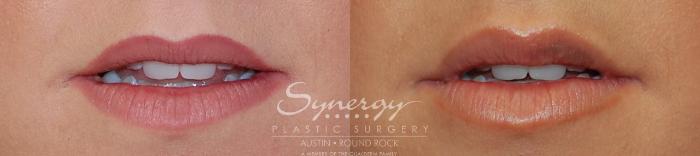 Before & After Injectable Fillers (Lips) Case 16 View #2 View in Austin, TX