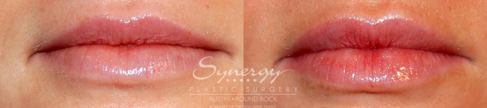 Before & After Injectable Fillers (Lips) Case 17 View #1 View in Austin, TX