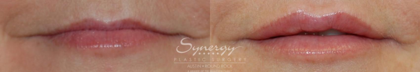 Before & After Injectable Fillers (Lips) Case 27 View #1 View in Austin, TX