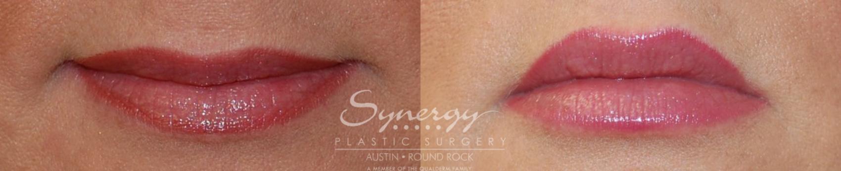 Before & After Injectable Fillers (Lips) Case 35 View #1 View in Austin, TX