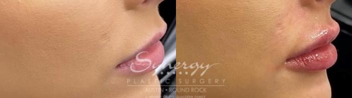 Before & After Injectable Fillers (Lips) Case 836 Left Side View in Austin, TX