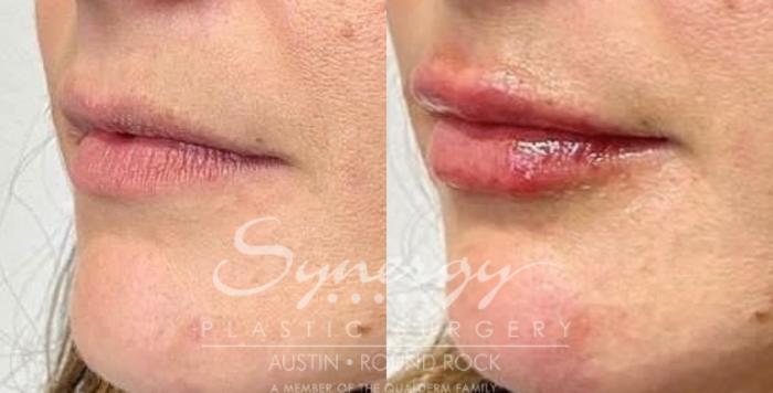 Before & After Injectable Fillers (Lips) Case 837 Right Oblique View in Austin, TX