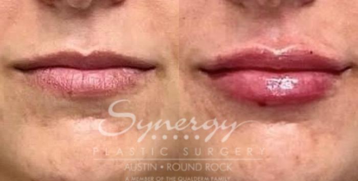 Before & After Injectable Fillers (Lips) Case 838 Front View in Austin, TX