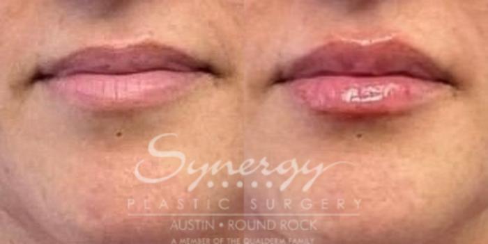 Before & After Injectable Fillers (Lips) Case 839 Front View in Austin, TX