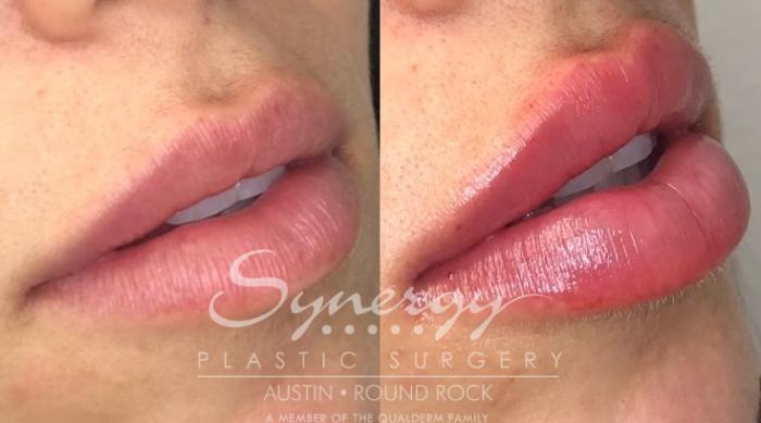 Before & After Injectable Fillers (Lips) Case 841 Left Oblique View in Austin, TX