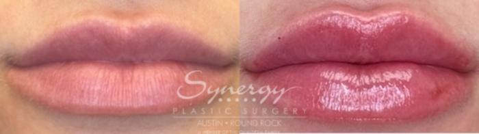 Before & After Injectable Fillers (Lips) Case 846 Front View in Austin, TX