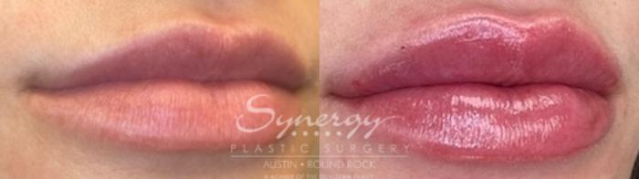 Before & After Injectable Fillers (Lips) Case 846 Left Oblique View in Austin, TX