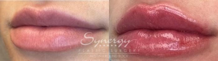 Before & After Injectable Fillers (Lips) Case 846 Right Oblique View in Austin, TX