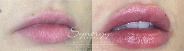 Before & After Injectable Fillers (Lips) Case 847 Left Oblique View in Austin, TX
