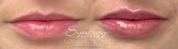 Before & After Injectable Fillers (Lips) Case 849 Front View in Austin, TX