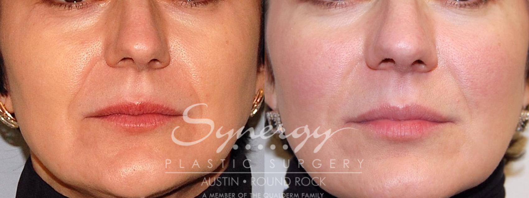 Before & After Injectable Fillers (Wrinkles) Case 19 View #1 View in Austin, TX