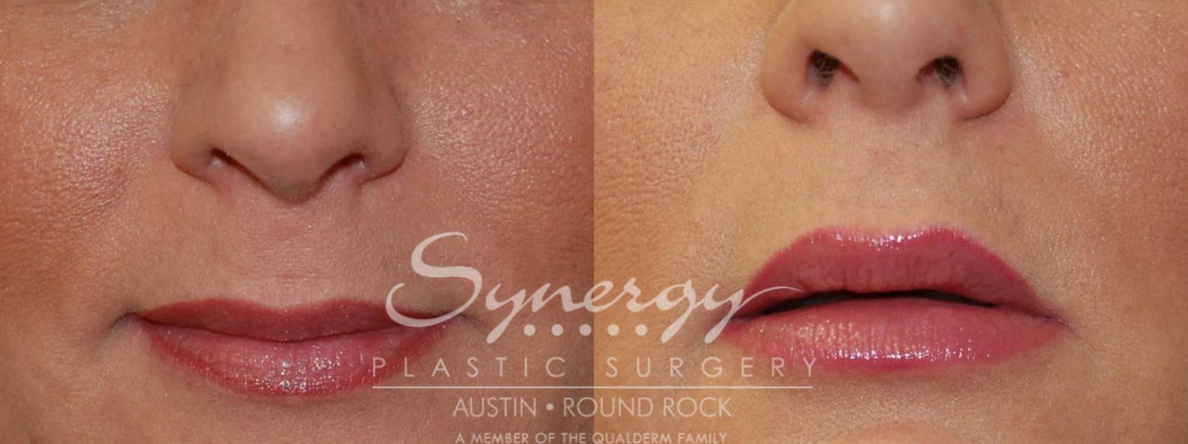 Before & After Injectable Fillers (Wrinkles) Case 36 View #1 View in Round Rock, TX