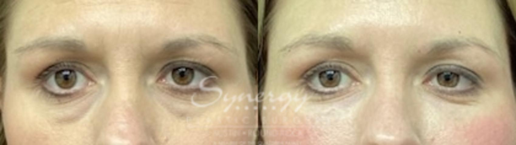 Before & After Injectable Fillers (Wrinkles) Case 852 Front View in Austin, TX