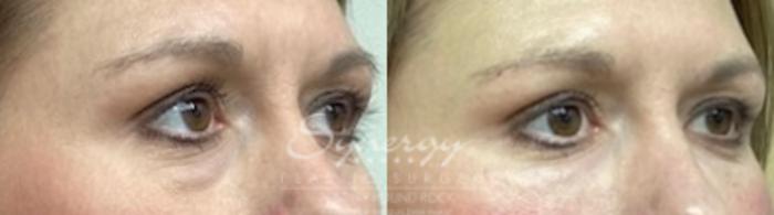 Before & After Injectable Fillers (Wrinkles) Case 852 Left Oblique View in Austin, TX