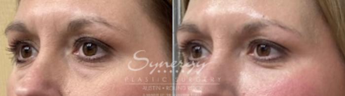 Before & After Injectable Fillers (Wrinkles) Case 852 Right Oblique View in Austin, TX