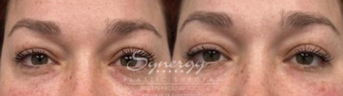 Before & After Injectable Fillers (Wrinkles) Case 853 Front View in Austin, TX