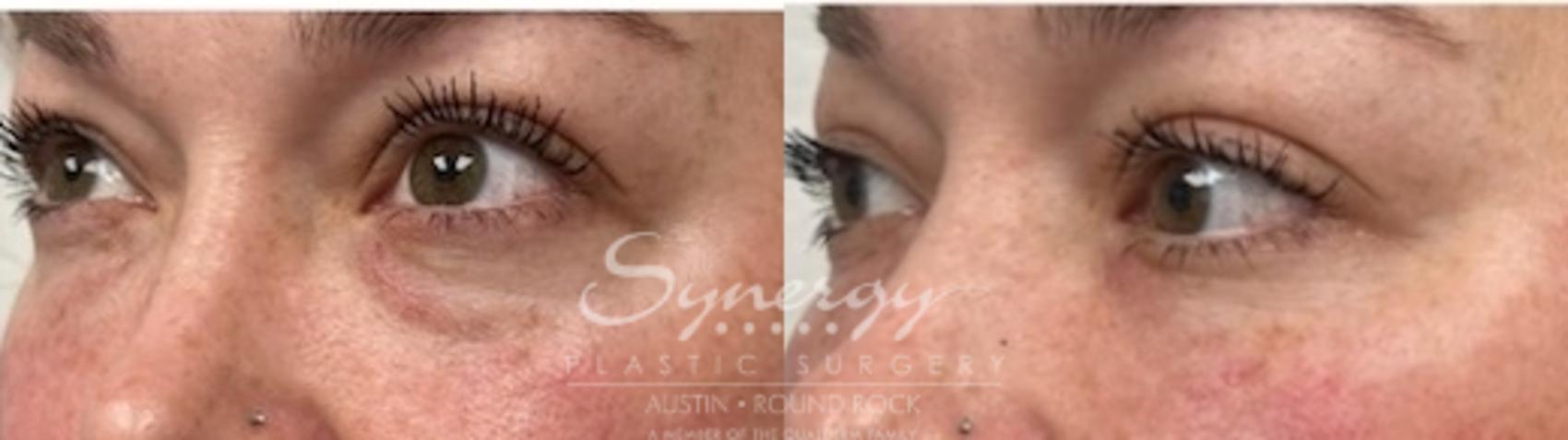 Before & After Injectable Fillers (Wrinkles) Case 853 Right Oblique View in Austin, TX