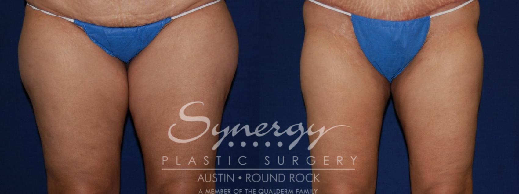 Before & After Liposuction Case 107 View #1 View in Round Rock, TX