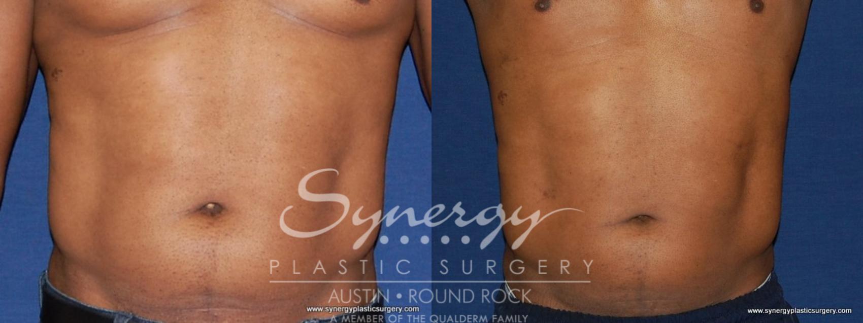 Before & After Liposuction Case 191 View #1 View in Round Rock, TX