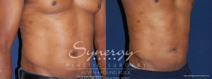 Before & After Liposuction Case 191 View #2 View in Round Rock, TX