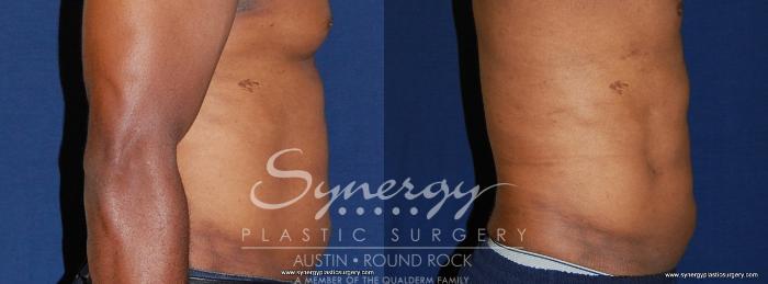 Before & After Liposuction Case 191 View #4 View in Round Rock, TX