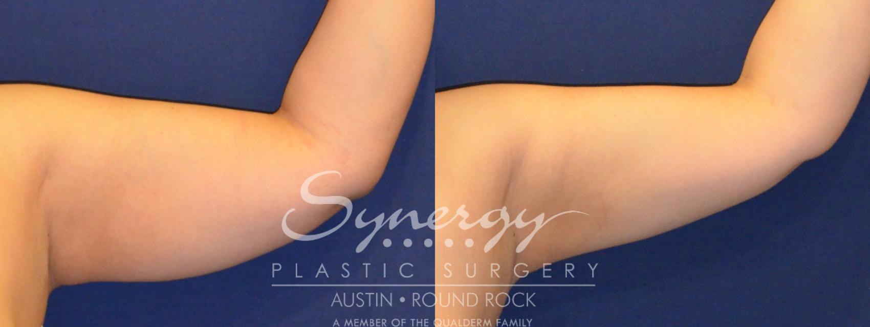 Before & After Liposuction Case 287 View #1 View in Austin, TX