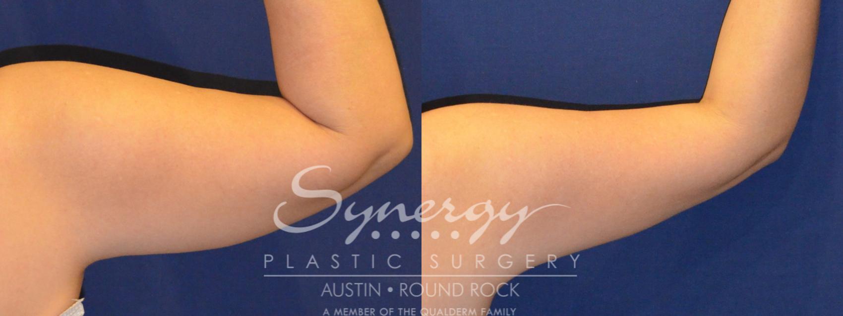 Before & After Liposuction Case 287 View #2 View in Round Rock, TX