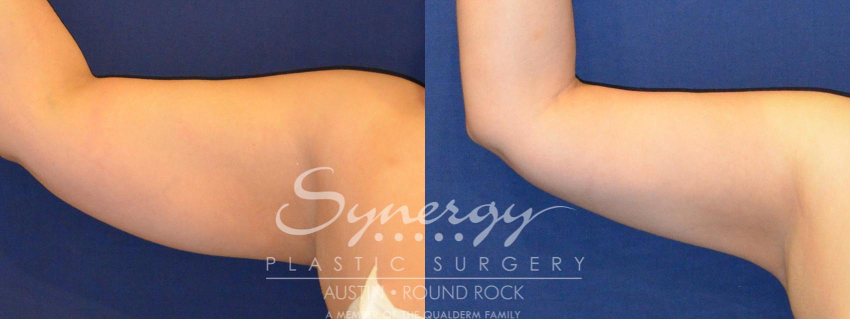 Before & After Liposuction Case 287 View #3 View in Round Rock, TX
